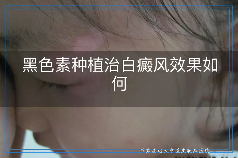 黑色素种植治白癜风效果如何