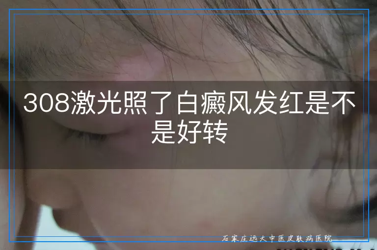 308激光照了白癜风发红是不是好转