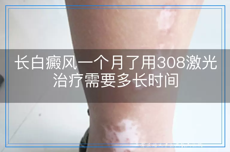 长白癜风一个月了用308激光治疗需要多长时间