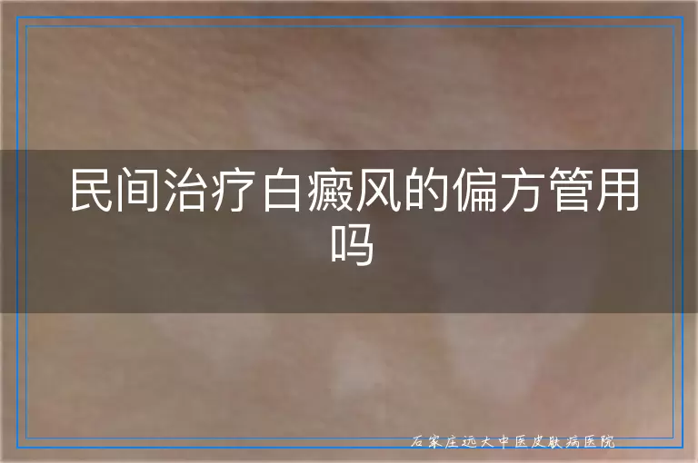 民间治疗白癜风的偏方管用吗