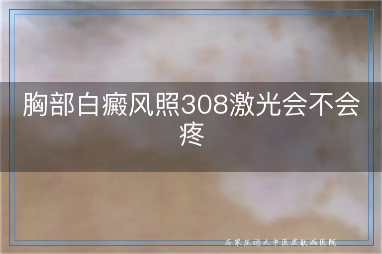 胸部白癜风照308激光会不会疼