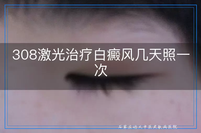 308激光治疗白癜风几天照一次