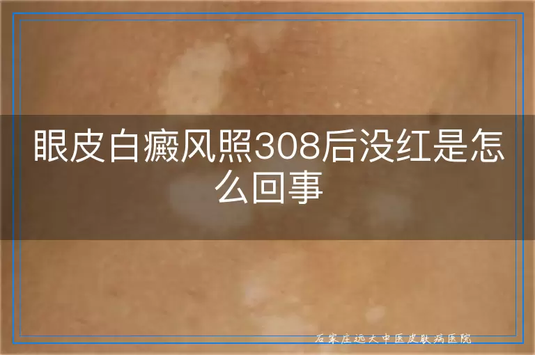 眼皮白癜风照308后没红是怎么回事