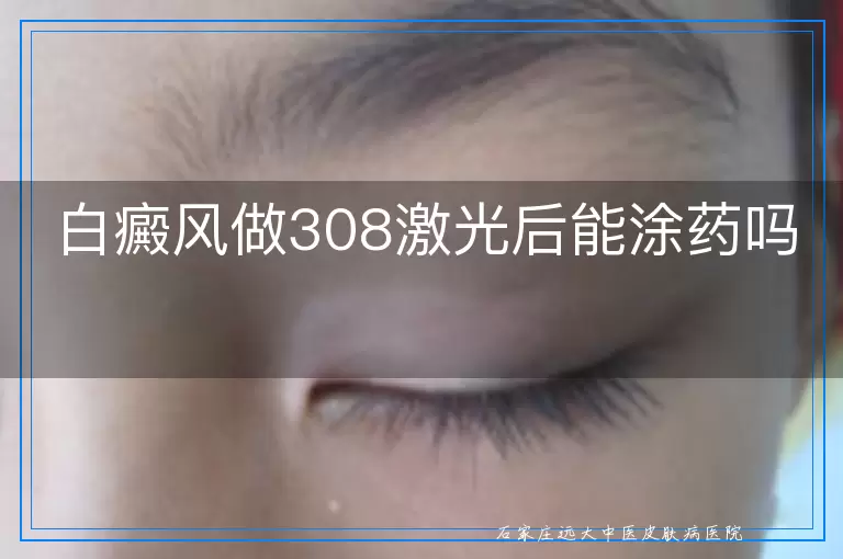白癜风做308激光后能涂药吗