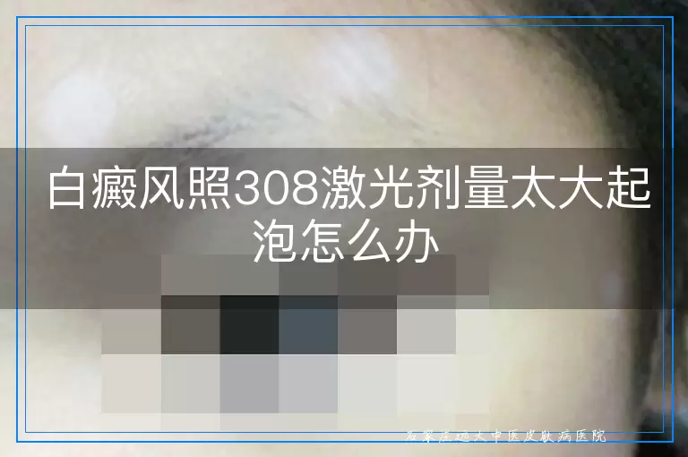 白癜风照308激光剂量太大起泡怎么办