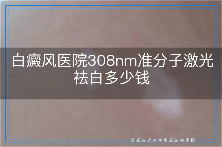 白癜风医院308nm准分子激光祛白多少钱