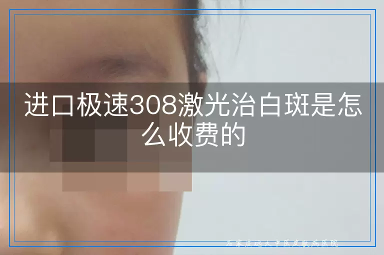 进口极速308激光治白斑是怎么收费的