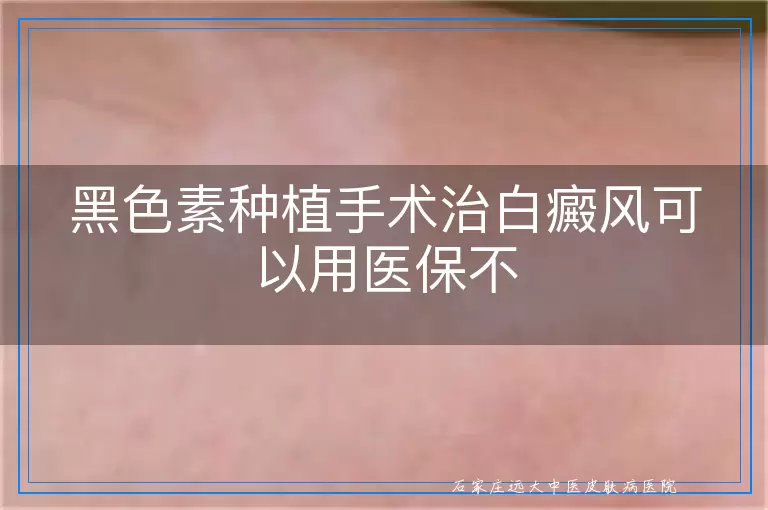 黑色素种植手术治白癜风可以用医保不