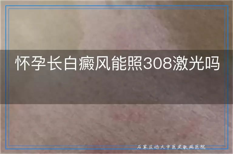 怀孕长白癜风能照308激光吗