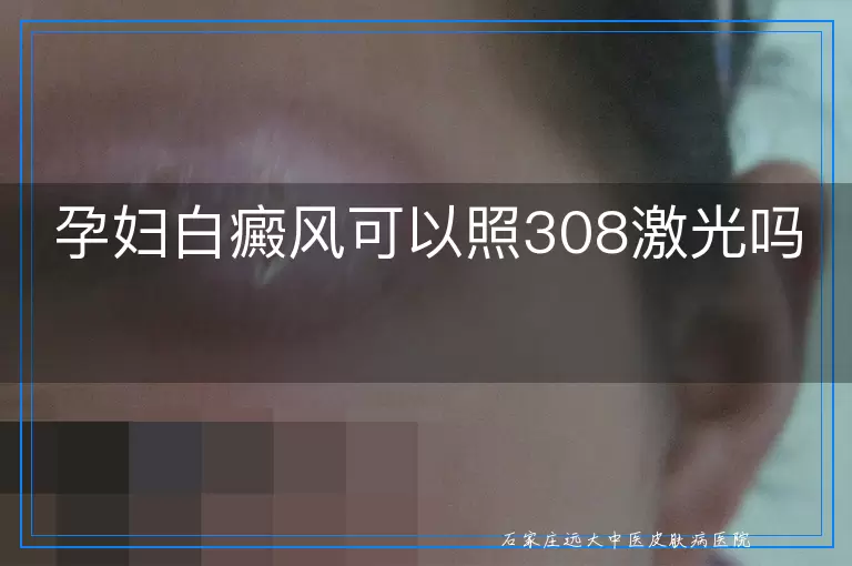 孕妇白癜风可以照308激光吗