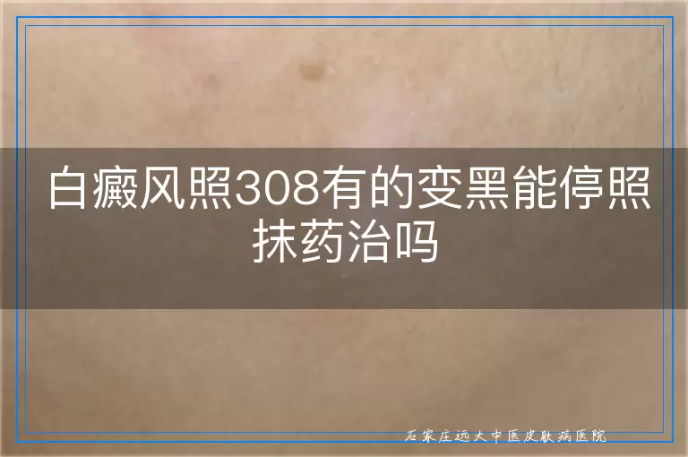 白癜风照308有的变黑能停照抹药治吗