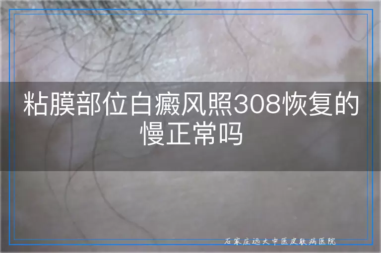 粘膜部位白癜风照308恢复的慢正常吗