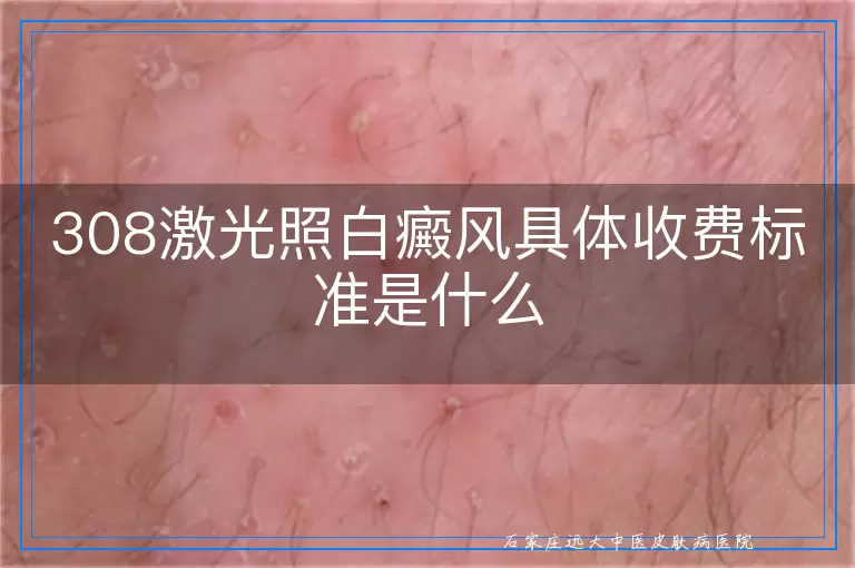 308激光照白癜风具体收费标准是什么