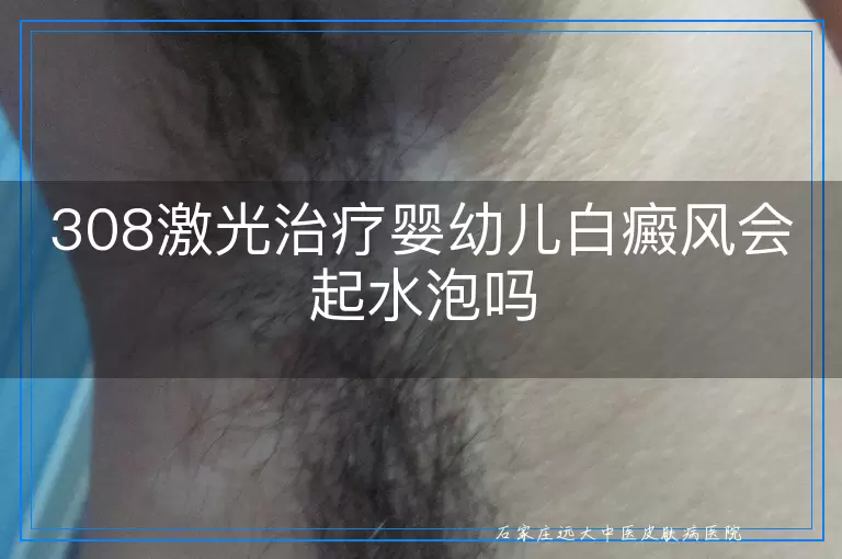 308激光治疗婴幼儿白癜风会起水泡吗