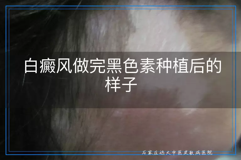 白癜风做完黑色素种植后的样子