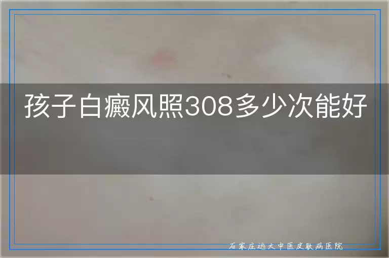 孩子白癜风照308多少次能好