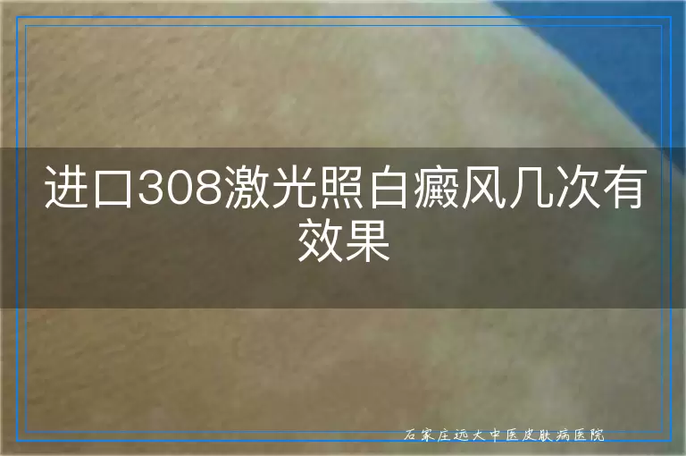 进口308激光照白癜风几次有效果