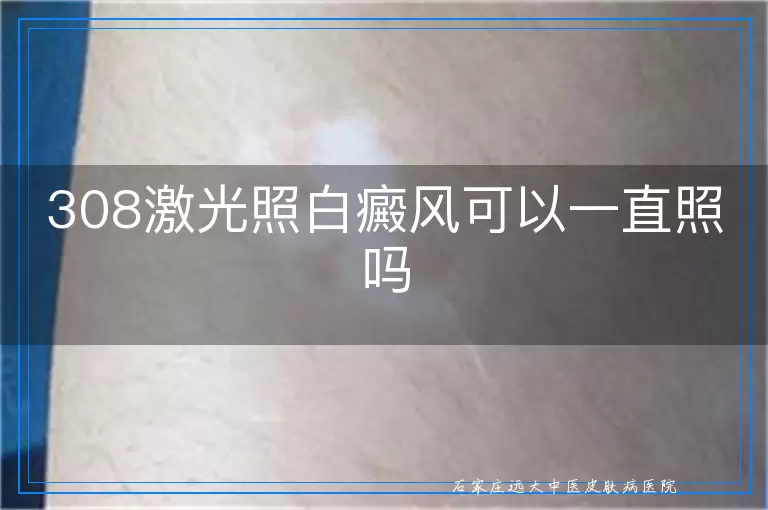 308激光照白癜风可以一直照吗