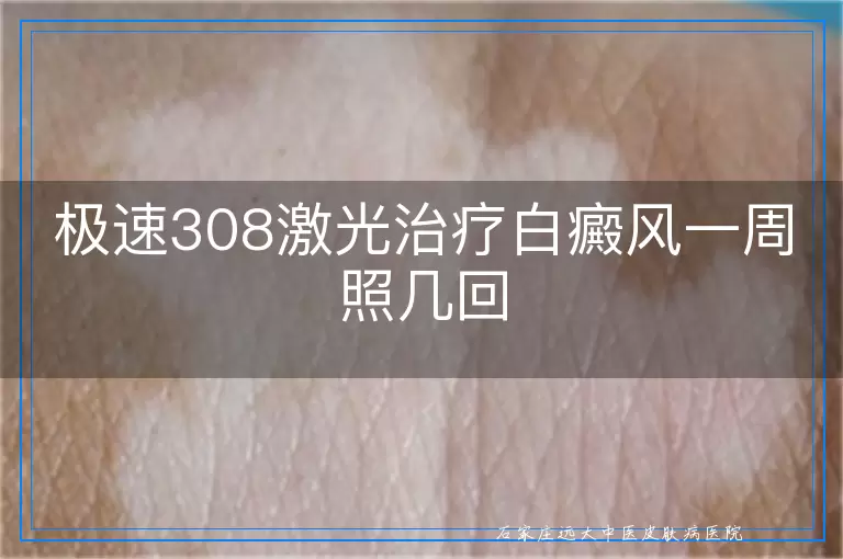 极速308激光治疗白癜风一周照几回