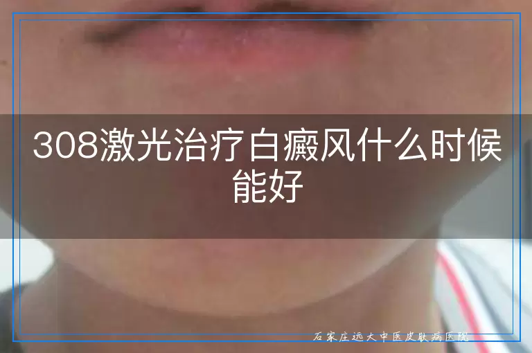 308激光治疗白癜风什么时候能好