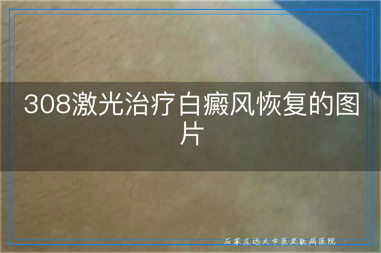 308激光治疗白癜风恢复的图片