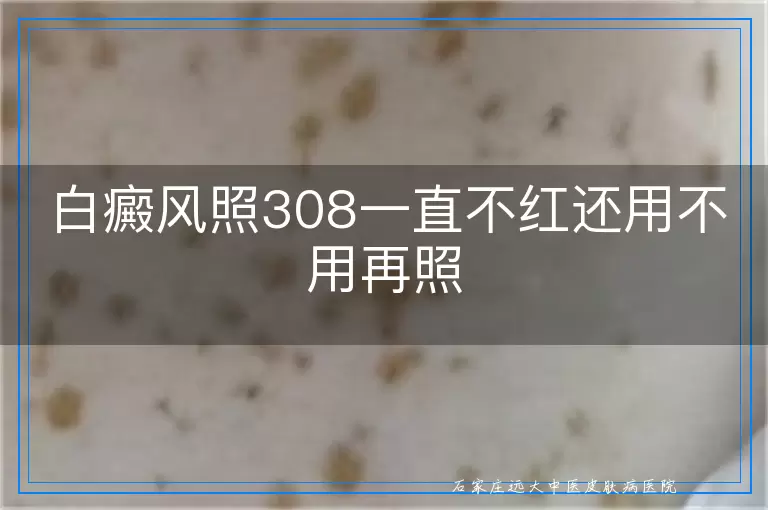 白癜风照308一直不红还用不用再照