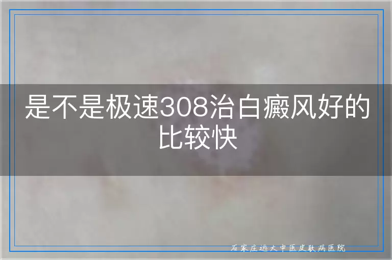 是不是极速308治白癜风好的比较快