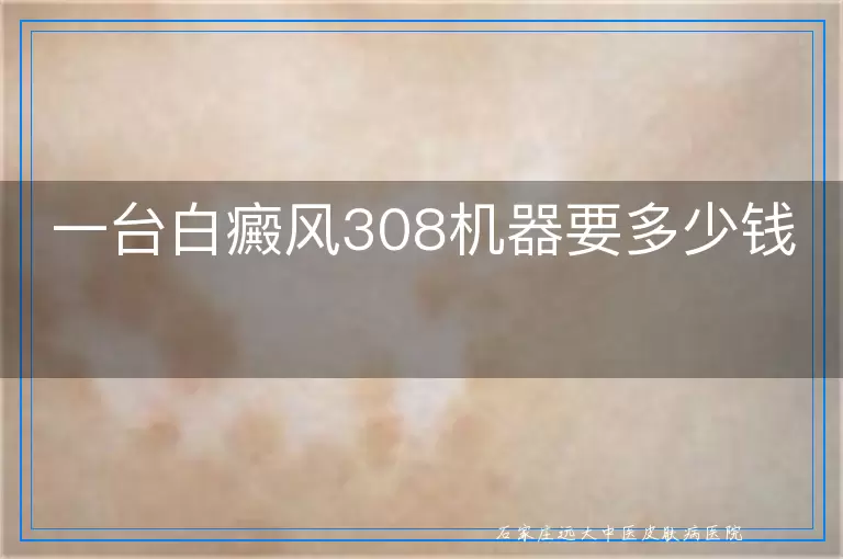 一台白癜风308机器要多少钱