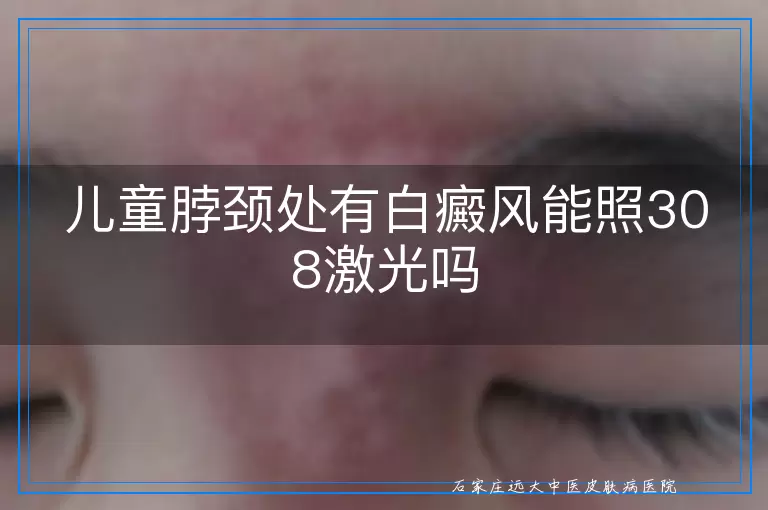 儿童脖颈处有白癜风能照308激光吗