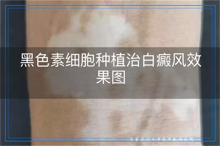 黑色素细胞种植治白癜风效果图