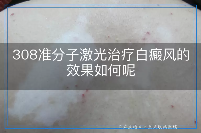 308准分子激光治疗白癜风的效果如何呢