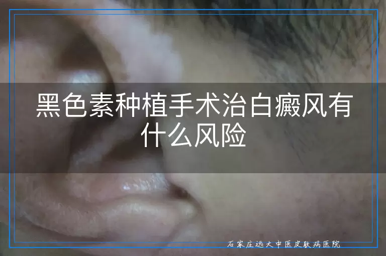 黑色素种植手术治白癜风有什么风险