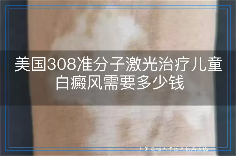 美国308准分子激光治疗儿童白癜风需要多少钱