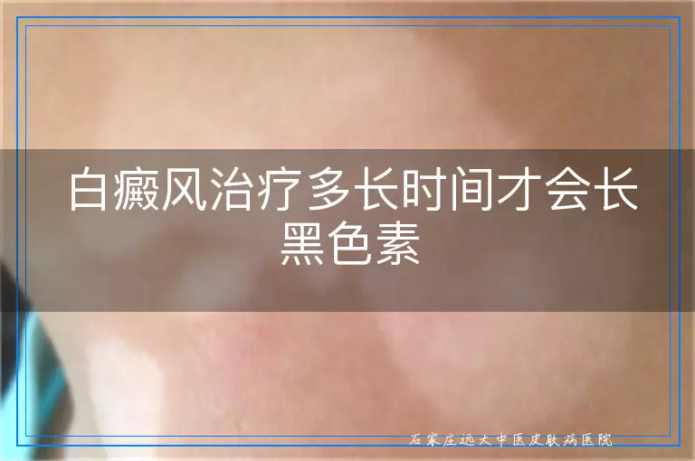 白癜风治疗多长时间才会长黑色素