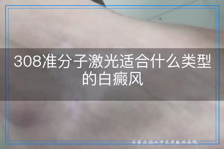 308准分子激光适合什么类型的白癜风