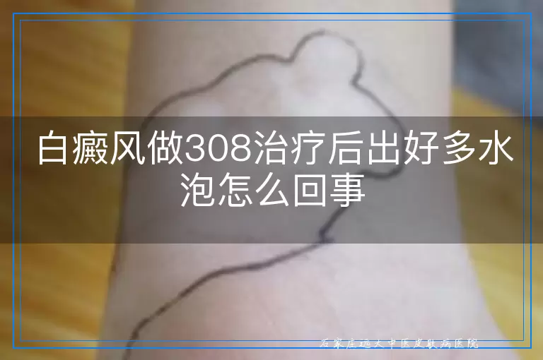 白癜风做308治疗后出好多水泡怎么回事
