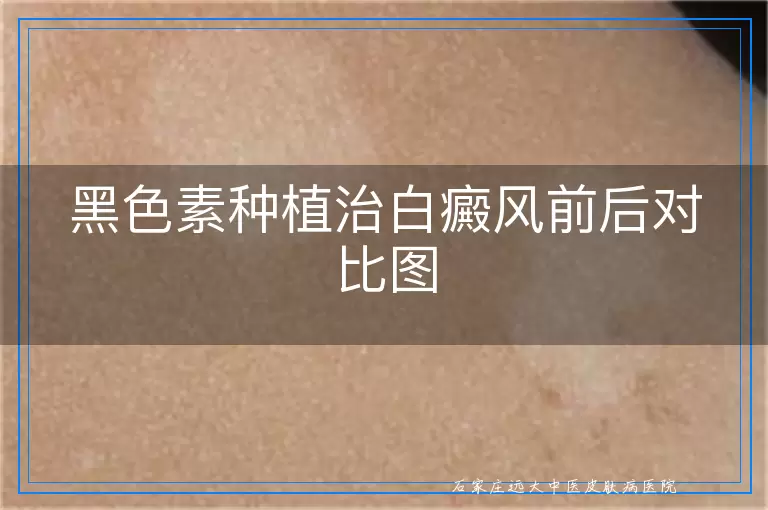 黑色素种植治白癜风前后对比图