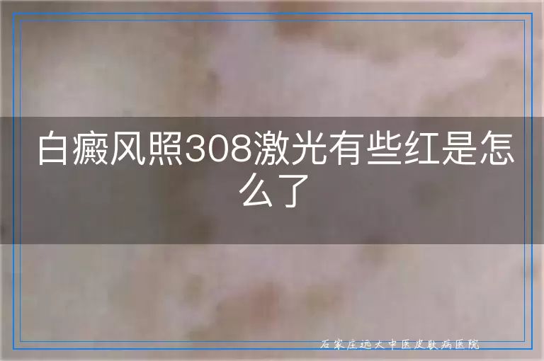 白癜风照308激光有些红是怎么了