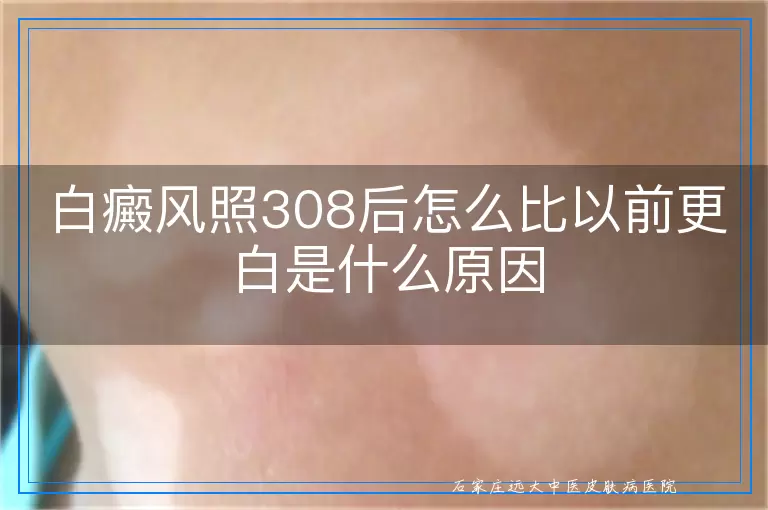 白癜风照308后怎么比以前更白是什么原因