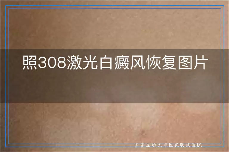 照308激光白癜风恢复图片