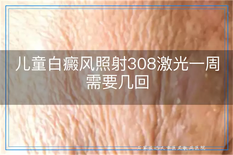 儿童白癜风照射308激光一周需要几回