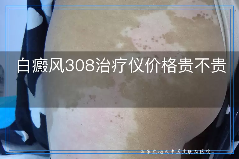 白癜风308治疗仪价格贵不贵