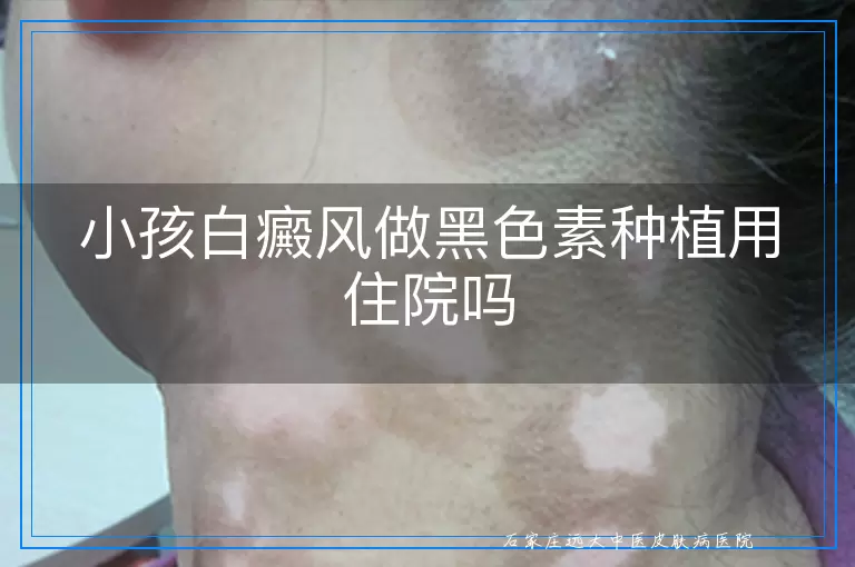 小孩白癜风做黑色素种植用住院吗