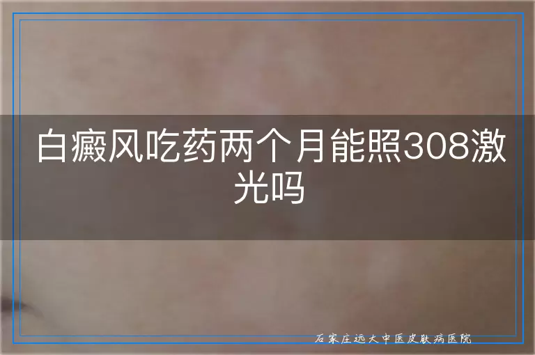 白癜风吃药两个月能照308激光吗