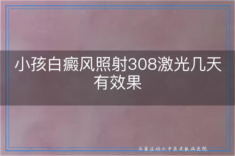 小孩白癜风照射308激光几天有效果