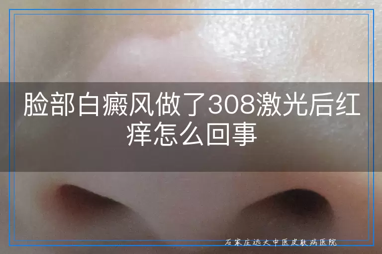 脸部白癜风做了308激光后红痒怎么回事