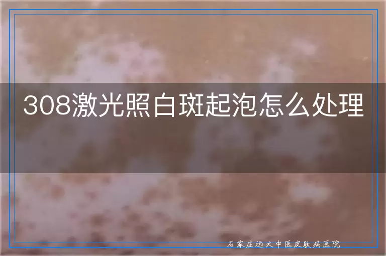 308激光照白斑起泡怎么处理