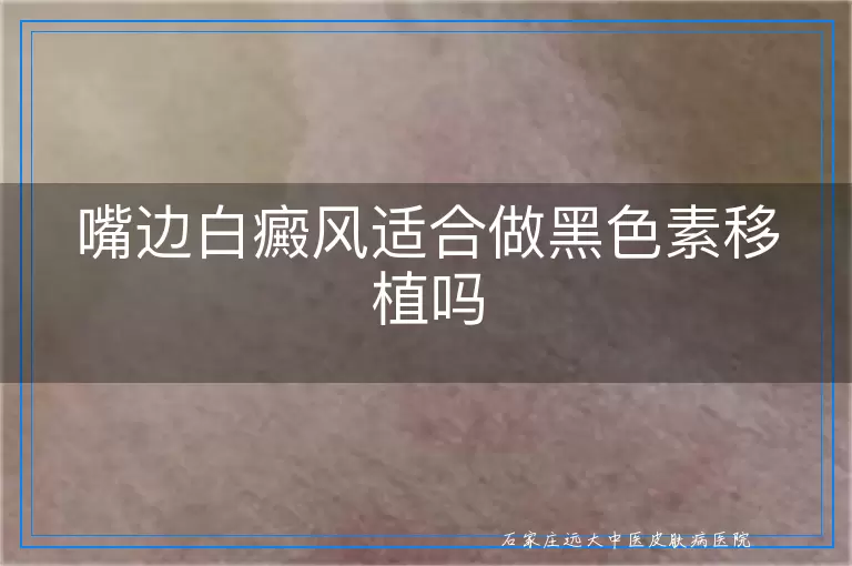 嘴边白癜风适合做黑色素移植吗