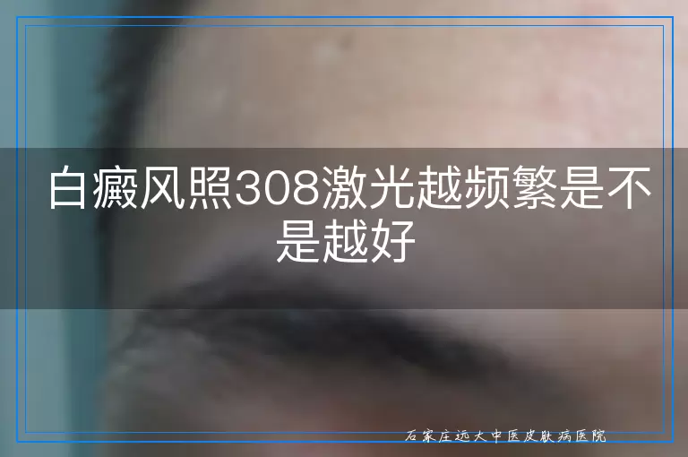 白癜风照308激光越频繁是不是越好