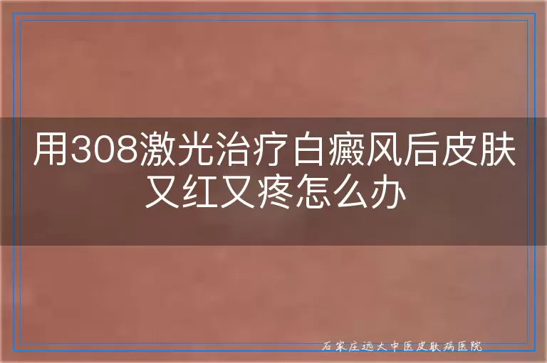 用308激光治疗白癜风后皮肤又红又疼怎么办